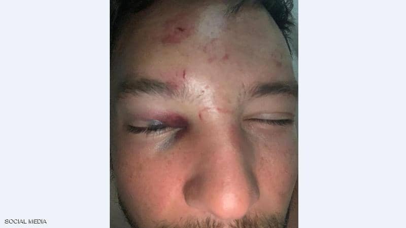 صورة.. لاعب تشيلسي يتعرض للضرب المبرح بسبب تماديه في "التحرش"