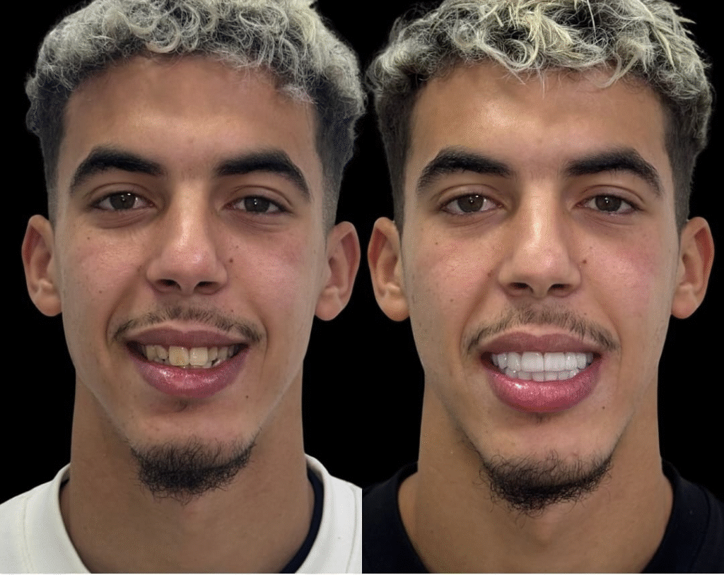 ياسر الزبيري يشعل منصات التواصل بابتسامته الجديدة بعد عملية تجميل الأسنان