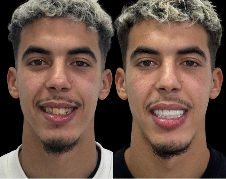 ياسر الزبيري يشعل منصات التواصل بابتسامته الجديدة بعد عملية تجميل الأسنان